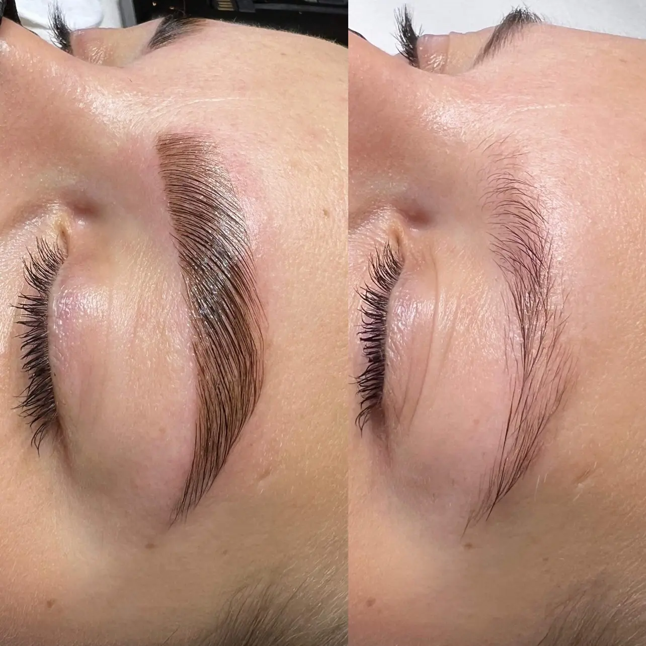 brow lifting frankfurt